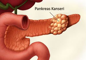 Pankreas Kanseri